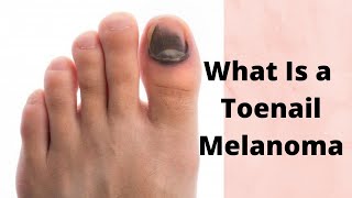 What Is a Toenail Melanoma [upl. by Corina]