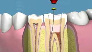 trattamento endodontico manuale e applicazione corona [upl. by Ocirederf]