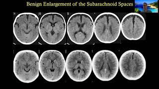 Abusive Head Trauma  evidences and controversies [upl. by Ffej]