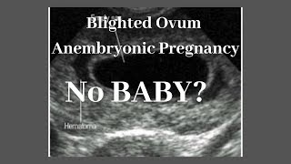 ANO ANG BLIGHTED OVUM or ANEMBRYONIC PREGNANCY WAG MAWALAN NG PAGASA MAY CHANCE PA MABUO ANG BABY [upl. by Bruce]