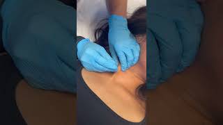 Dry needling of the SCM for the treatment of neck pain [upl. by Mure]