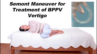 Semont Maneuver for BPPV Vertigo Treatment Alternative to Epley Maneuver [upl. by Runck]