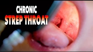 CHRONIC STREP THROAT  Cute Baby Alert  Dr Paul [upl. by Naihs]