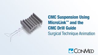 CMC Suspension Using MicroLink™ and CMC Drill Guide  CONMED Animation [upl. by Nomaj]