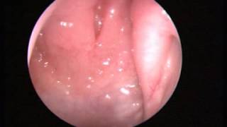 Video 1 Normal nasal endoscopy [upl. by Ainahtan]