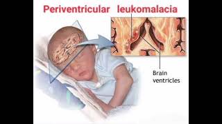 Periventricular leukomalacia mrcpch Communication [upl. by Norb]