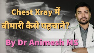 Chest Xray of Lung disease explained in hindi by DrAnimesh MS dranimesh surgeryonline pneumonia [upl. by Onifled]