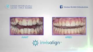 Cas Clinique  INVISALIGN [upl. by Alihs]