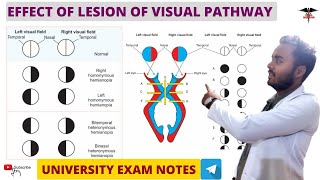 Effect Of Lesion On Visual Pathway  Special Sense Physiology [upl. by Prussian850]