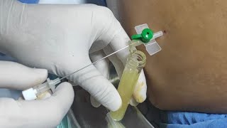 Remove abdominal fluid ascites  Paracentesis  Ascitic fluid aspiration [upl. by Sarazen]