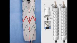 Dr Gustavo Oderich  Physician Modified Fenestrated Endografts Technical Aspects and Outcomes [upl. by Ecille984]