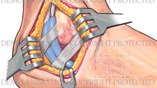 Ankle Arthroscopy and Open Repair [upl. by Milton]