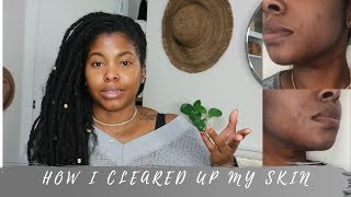 How I Cleared my Acne  Got Rid of My Dark Spots [upl. by Rednazxela]