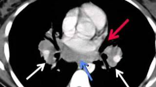 LearningRadiology 55 Sarcoidosis [upl. by Hareema]