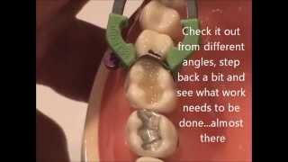 Maxillary Composite Placement WREB [upl. by Chae]