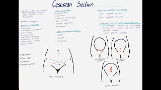 Cesarean Section  Types Indications Incisions etc [upl. by Ogir]