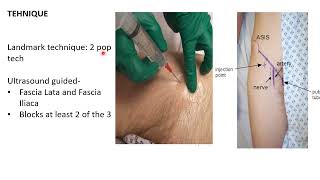 Fascia Iliaca Compartment Block FIB  Emergency Medicine [upl. by Philbrook448]