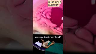 Burr hole surgery  for intracranial bleed surgery medical brainsurgery [upl. by Anyehs215]