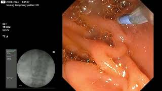 Trapezoid lithotripsy  how I do it [upl. by Ardnuahc]