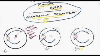 clinically significant macular edema [upl. by Meras]