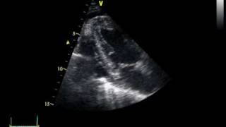 CHRONIC PERICARDITIS with thickening of the pericardium [upl. by Yroj]