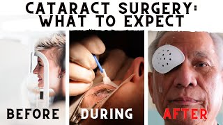 What To Expect Before During And After Cataract Surgery [upl. by Zitah]