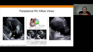 Joint Echo Conference Structural Heart TV Intervention [upl. by Aneehsyt]