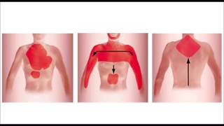 Infarctus du myocarde [upl. by Gnuhn]