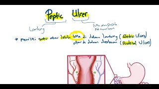 Patofisiologi  Tukak Lambung Peptic Ulser [upl. by Jsandye285]