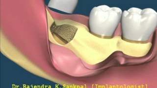 Surgical Extraction of wisdom tooth close to nerves [upl. by Runkle]