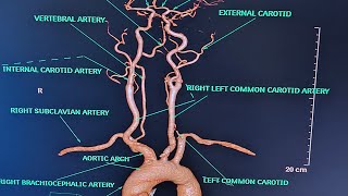 BRAIN AND NECK ANGIOGRAPHY On Ct scanALL ABOUT ANGIOGRAPHYPART1CONCEPT ON ANGIOGRAPHY [upl. by Llenrad]