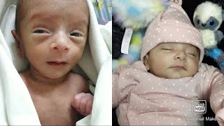 Premature Baby  IUGR  3 months old update [upl. by Kamillah]