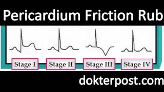 pericardium friction rub [upl. by Liebermann]