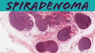 Spiradenoma 5Minute Pathology Pearls [upl. by Bixler455]