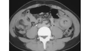 Multiple Intussusception with lymphoma patient [upl. by Berne113]