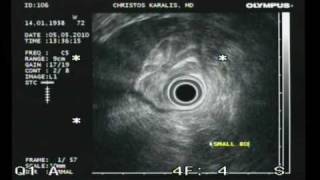 CHRONIC PANCREATITIS ENDOSCOPIC ULTRASOUND CHRISTOS KARALIS MDwmv [upl. by Anirbes497]