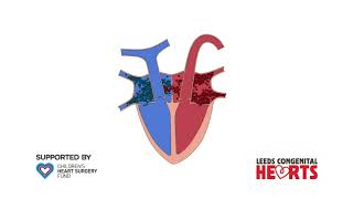 Atrial Septal Defect and Surgical Closure [upl. by Eelrak717]