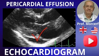 There are more details in the echocardiogram of pericardial effusion than you think [upl. by Tai]