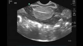 How to Female Transvaginal Ultrasound Exam [upl. by Godwin]