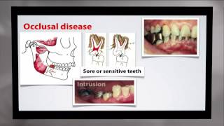 Choroba okluzyjna  najczęstsza przyczyna utraty zębów [upl. by Coh]