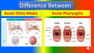 Difference Between Acute Otitis Media and Acute Pharyngitis [upl. by Harmaning4]