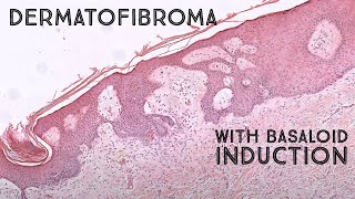 Dermatofibroma with basaloid follicular induction mimic of basal cell carcinoma pathology [upl. by Ilyssa]