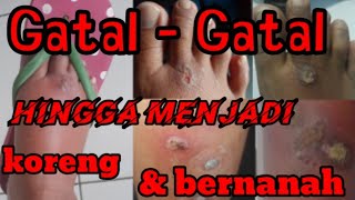 Obat Gatal  Gatal koreng dan bernanah paling ampuh [upl. by Falcone]