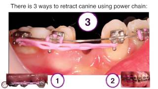 canine traction by power chain in orthodontics by dr Amr Asker [upl. by Anitsihc]