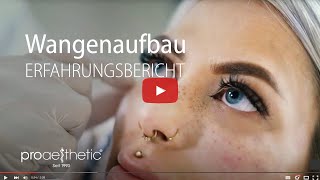 Wangenaufbau mit Hyaluron  Erfahrungsbericht  proaesthetic Heidelberg [upl. by Anad]