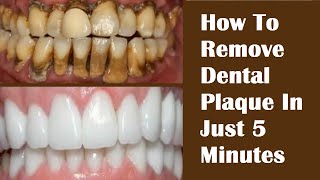 How To Remove Dental Plaque In Just 5 Minutes  Remove Tartar On Teeth FAST HealthyPunchToday [upl. by Aitnic289]