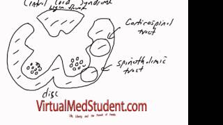 Central Cord Syndrome [upl. by Nytsirt]