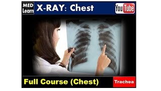 X RAY Chest 2 Trachea cme internalmedicine medicalstudent usmle محاضراتباطنة [upl. by Atews951]