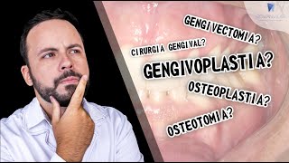 GENGIVOPLASTIA GENGIVECTOMIA CIRURGIA GENGIVAL SAIBA A DIFERENÇA drrowanvilar [upl. by Liek847]