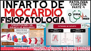 INFARTO AGUDO AL MIOCARDIO FISIOPATOLOGÍA  GuiaMed [upl. by Biron]